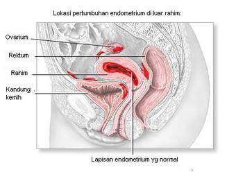 lokasi pertumbuhan endometriosis