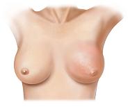 Gambar 1. Manfaat menyusui untuk mencegah kanker payudara