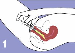 Gambar cara memasukkan spermisida bentuk busa krim atau jeli dengan inserter