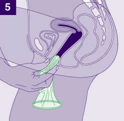 Gambar kondom wanita 5