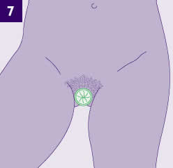 Gambar kondom wanita 7