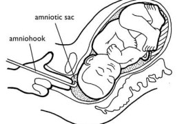 Amniotomy (Amniotomi atau Pecah Ketuban)